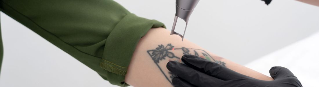laser para remoção de tatuagem